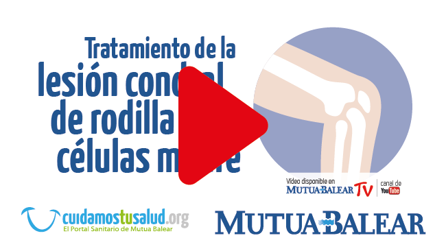 Tratamiento con células madre de la lesión condral de rodilla